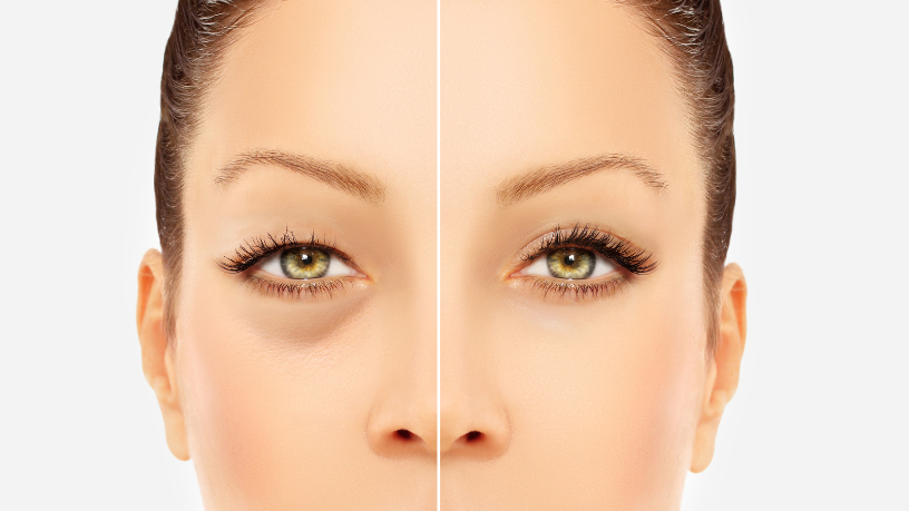 Para Milton Seigi Hayashi, entender a diferença entre blefaroplastia superior e inferior é essencial para bons resultados.